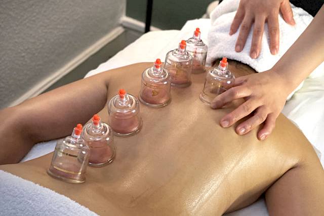 Cupping Therapy